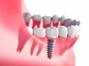 A single tooth dental implant which our implant dentist in Arlington, TX, would place
