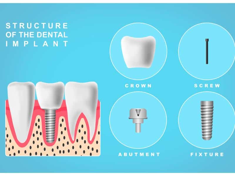 An illustration of how dental implants work